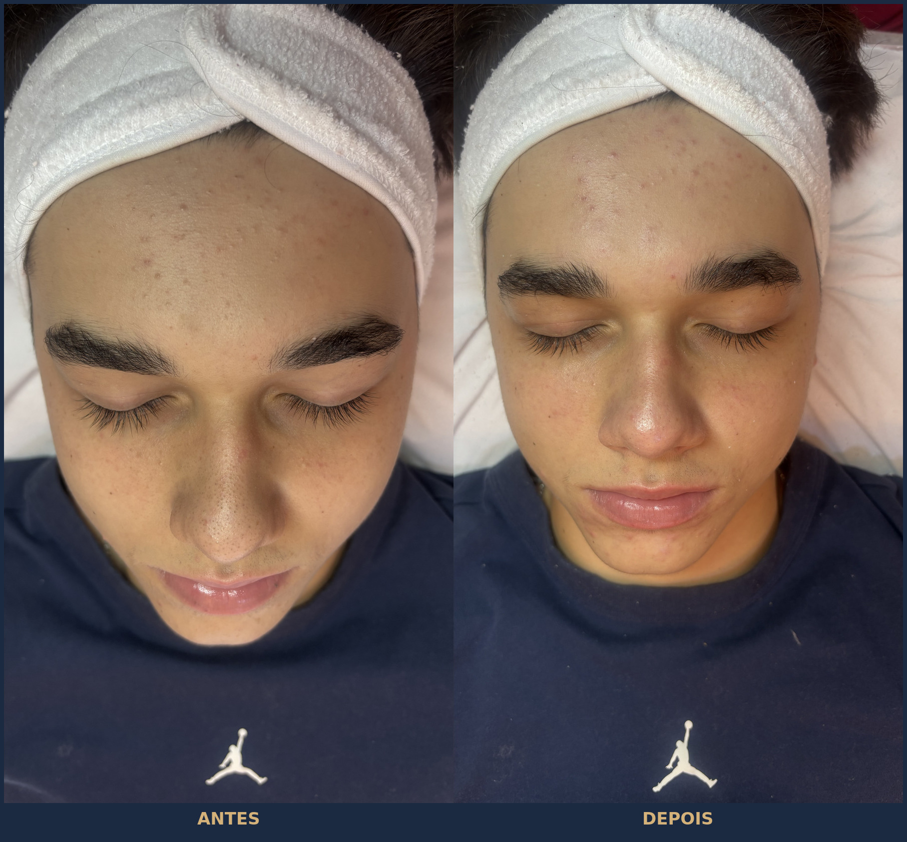 Antes e depois da limpeza de pele profunda no consultório da Dra. Laura Sá em Juiz de Fora