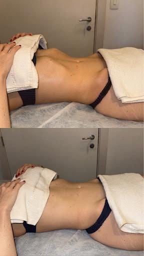 Resultado antes e depois do protocolo DrenaShape de drenagem linfática